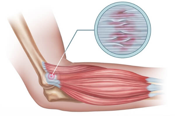 Tennis Elbow: Causes, Treatments & Prevention